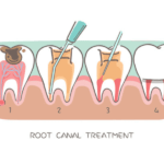 Types of Braces