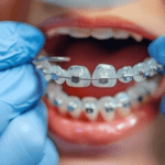 How Long Does a Root Canal Take: Everything You Need to Know