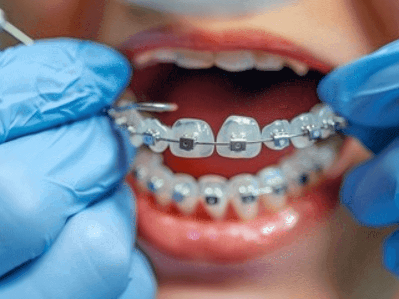 Types of Braces
