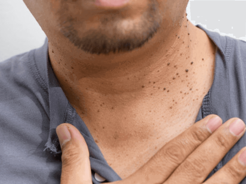 dr scholls skin tag remover